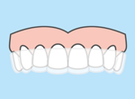 invisalign clear dental aligners