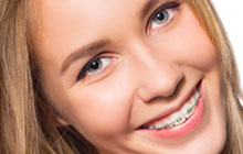 Bellevuedental teeth straightening