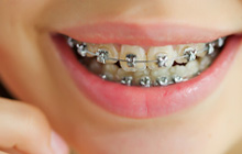 orthodontics - Bellevue Dental
