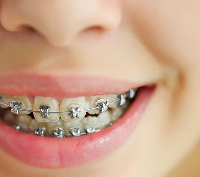 Orthodontics - bellevue dental clinic